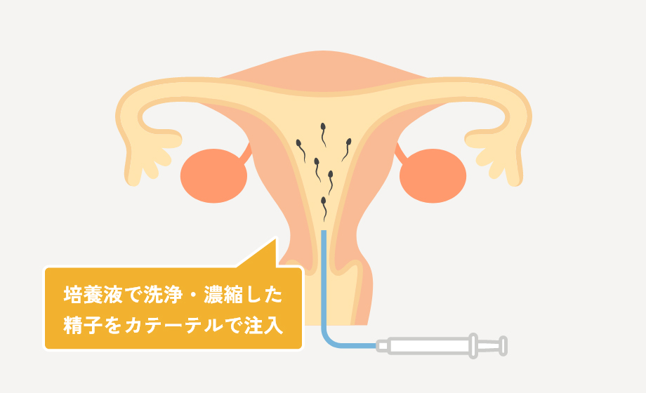 人工授精の実施方法
