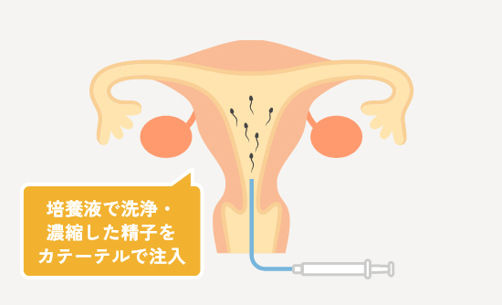 人工授精の実施方法