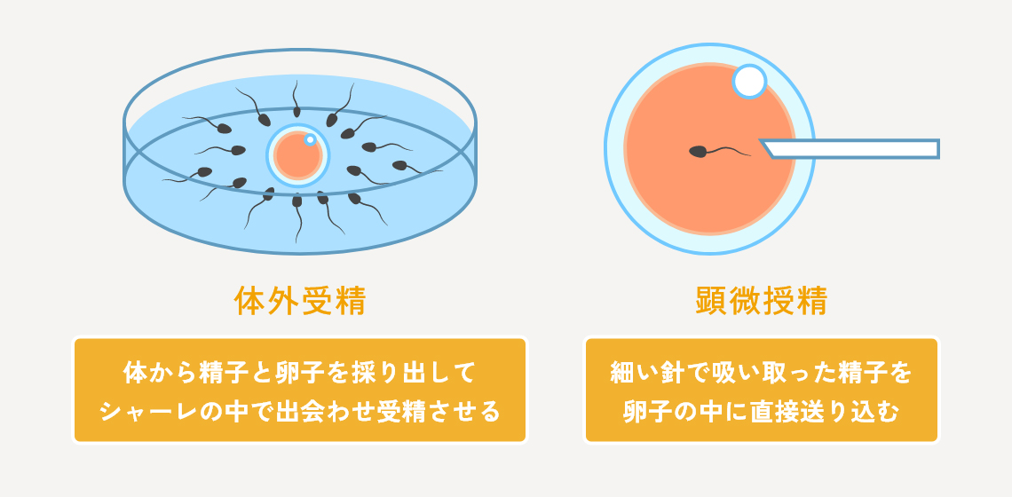 体外受精との違い