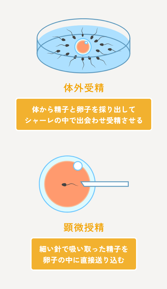 体外受精との違い